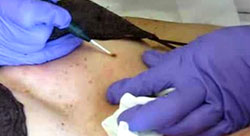 Benign Mole Removal