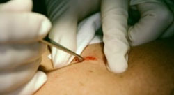 Cosmetic Mole Removal Cosmetic Mole Removal