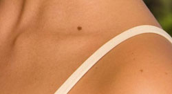 How Long Will Mole Removal Take How Long Will Mole Removal Take
