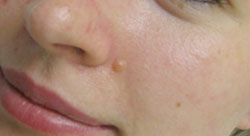 Instant Mole Removal