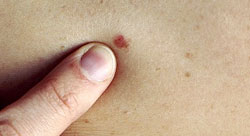 Is Mole Removal Safe Is Mole Removal Safe