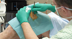 Med Weight Mole Removal Med Weight Mole Removal