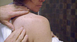 Melanoma and Mole Removal Melanoma and Mole Removal