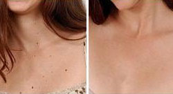 Mole Removal Dermatend Mole Removal Dermatend