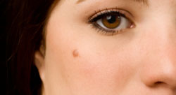 Mole Removal Reviews Mole Removal Reviews