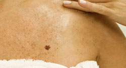 ProLase Mole Removal