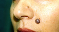Radiosurgical Mole Removal Radiosurgical Mole Removal