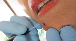 Radiowave Mole Removal