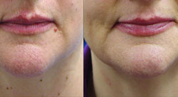 Rejuvena Clinic Mole Removal