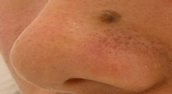 Sapphire Mole Removal Sapphire Mole Removal