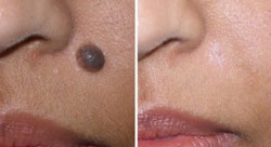 Skin Care & Laser Mole Removal