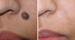 Skin Care & Laser Mole Removal Skin Care & Laser Mole Removal
