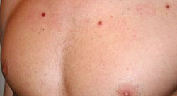 Skin Mole Removal
