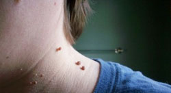 Skin Tag Mole Removal Skin Tag Mole Removal
