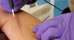 St. Mellion Clinic Mole Removal