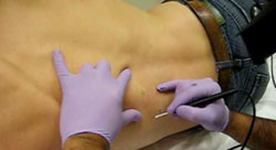 Mole Removal Scarring